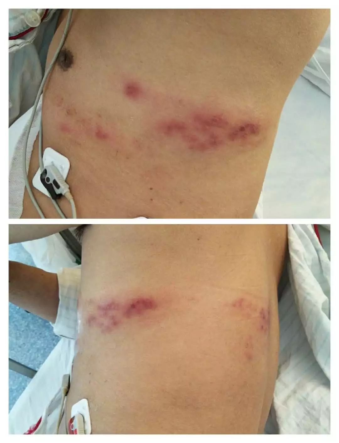 胸痛吃硝酸甘油缓解是怎么回事,发生胸痛为什么慎用硝酸甘油