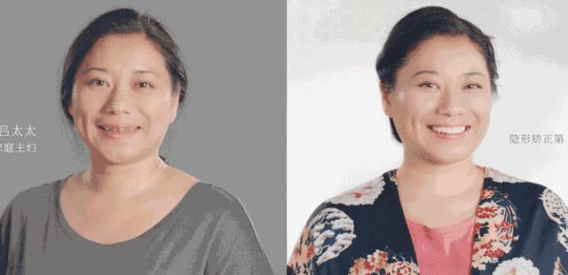 国家牙齿矫正种牙新政策,能全口种植牙齿一般需要多少钱