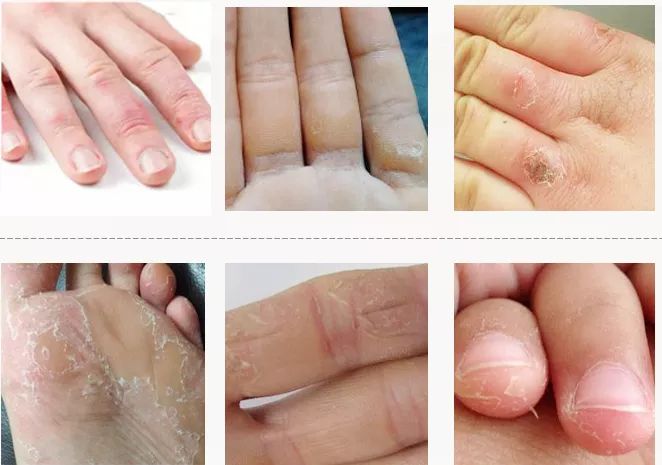 快速修复手干裂,冬季皮肤干燥脱皮面霜