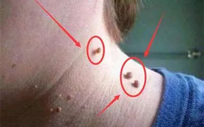 皮肤上的瘊子分公母吗,面部瘊子怎么知道公母