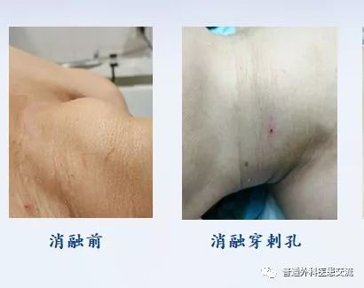 甲状腺无疤手术,甲状腺手术脖子会留疤吗
