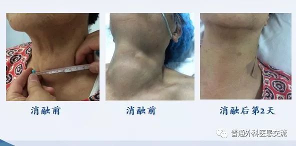 甲状腺无疤手术,甲状腺手术脖子会留疤吗