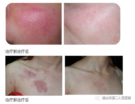 光子特惠,光子嫩肤优惠可以做吗