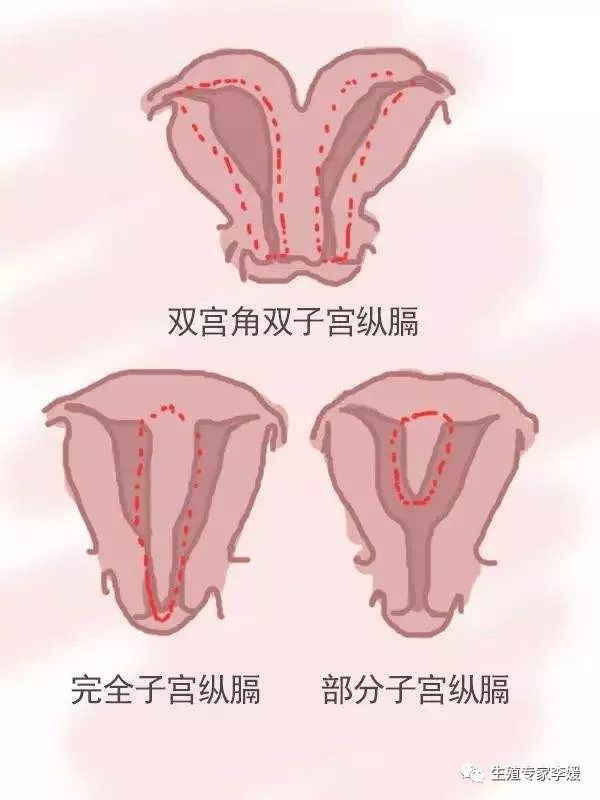 子宫畸形纵隔能做试管吗,子宫畸形能做试管吗