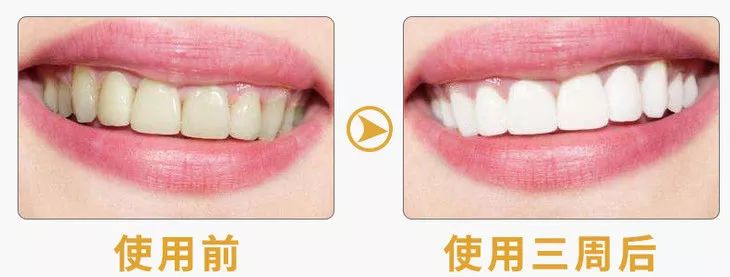 用了美白牙膏白了一颗牙,用了美白牙膏后还用清洁吗