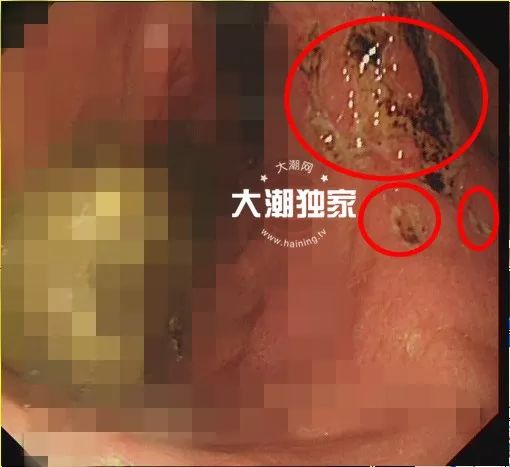 「925丨提醒」男子体内长了两大团……医生却说:快喝可乐!喝一个星期!