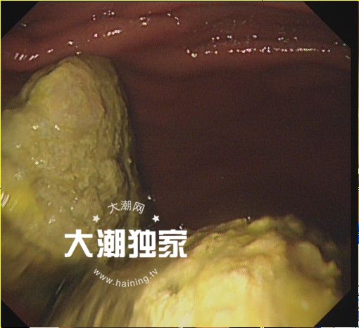 「925丨提醒」男子体内长了两大团……医生却说:快喝可乐!喝一个星期!