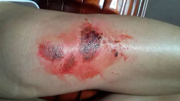 碘酒跟红药水的功能区别,碘酒和红药水区别