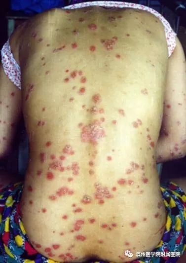 皮肤科专家真菌感染牛皮癣,还在受皮肤病困扰吗