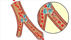 紧急救治脑卒中患者,医院真实脑卒中急救