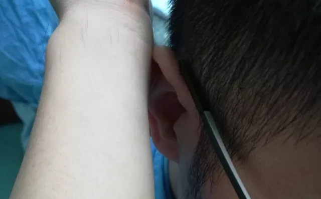 透析病人内瘘胀痛是怎么回事,透析病人内瘘血栓形成如何处理