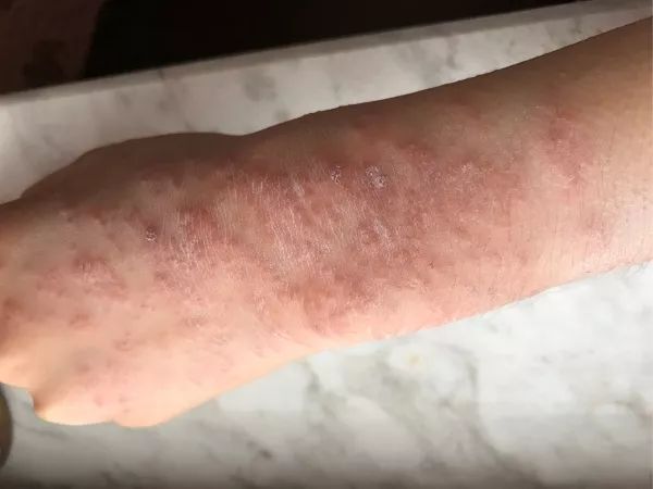 被海葵蜇了排毒要多久,戴着手套会被海葵蜇到吗