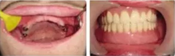 国家牙齿矫正种牙新政策,能全口种植牙齿一般需要多少钱