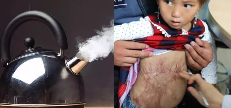 斑疤痘敏妊娠纹,伤痕印如何能快速消除