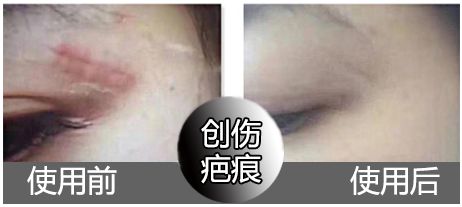 斑疤痘敏妊娠纹,伤痕印如何能快速消除