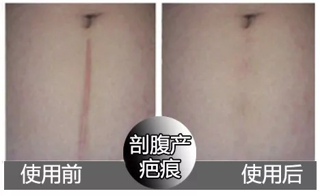 斑疤痘敏妊娠纹,伤痕印如何能快速消除