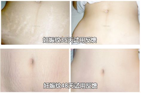 斑疤痘敏妊娠纹,伤痕印如何能快速消除