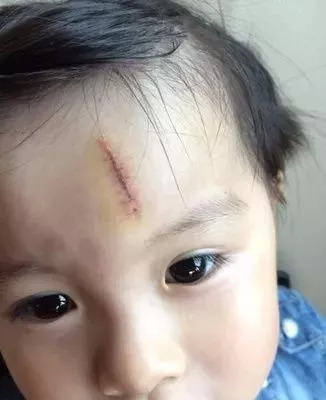 斑疤痘敏妊娠纹,伤痕印如何能快速消除