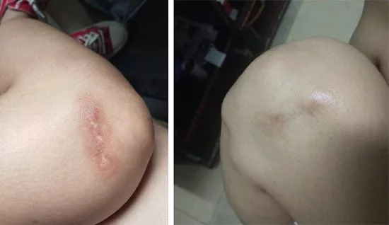 斑疤痘敏妊娠纹,伤痕印如何能快速消除