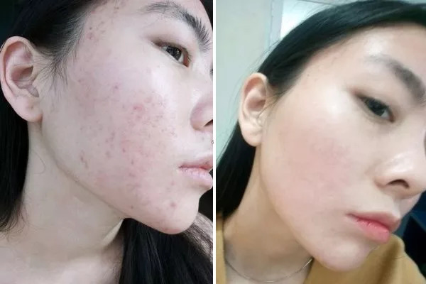 斑疤痘敏妊娠纹,伤痕印如何能快速消除