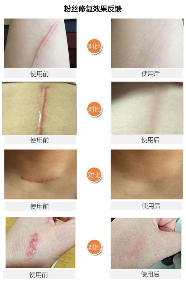 斑疤痘敏妊娠纹,伤痕印如何能快速消除