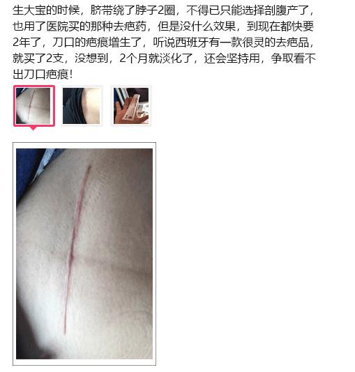 斑疤痘敏妊娠纹,伤痕印如何能快速消除