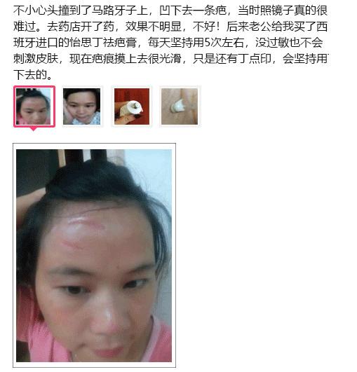 斑疤痘敏妊娠纹,伤痕印如何能快速消除