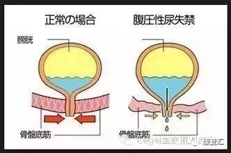产后康复盆底肌康复训练思路,产后盆底肌的康复运动方案