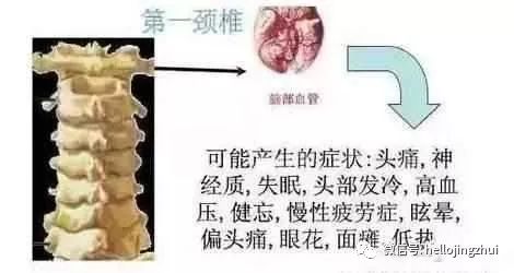 颈椎病压迫神经吃甲钴胺多长时间,颈椎病压迫神经微创手术要多少钱