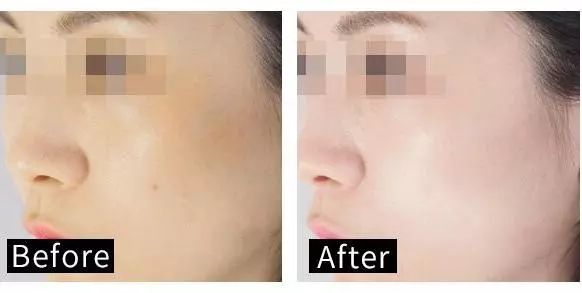 适合黑皮和黄皮的面膜,适合黄皮的mm面膜