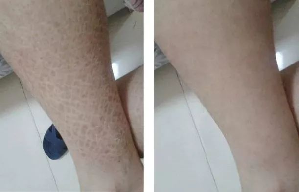 人脸上螨虫的数量,人脸上有多少螨虫