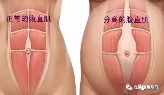 产后腹直肌分离盆底肌恢复训练,产后腹直肌分离一指恢复训练