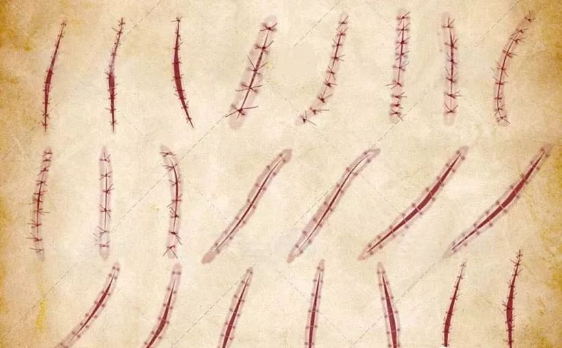 伤口没消毒可以洗澡吗,伤口没拆线能游泳吗