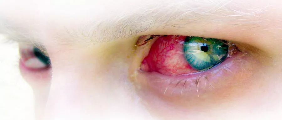 过敏性结膜炎的自愈方法,合并鼻痒要警惕过敏性结膜炎