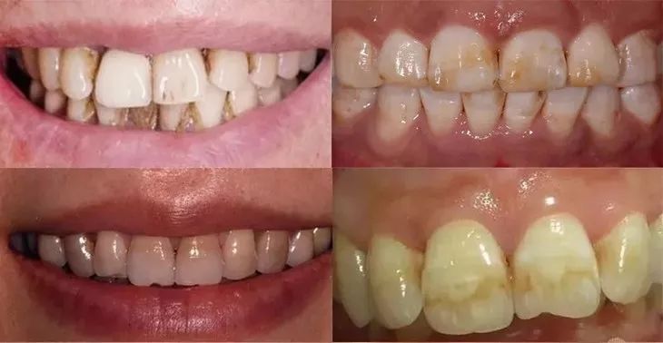 韩国钻石美白牙齿的牙膏好用吗,韩国牙膏排名第一名儿童