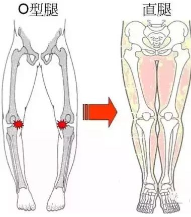 o型腿瑜伽视频,o型腿最快变直的瑜伽