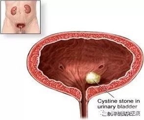 小心膀胱结石,膀胱结石的初期症状是什么
