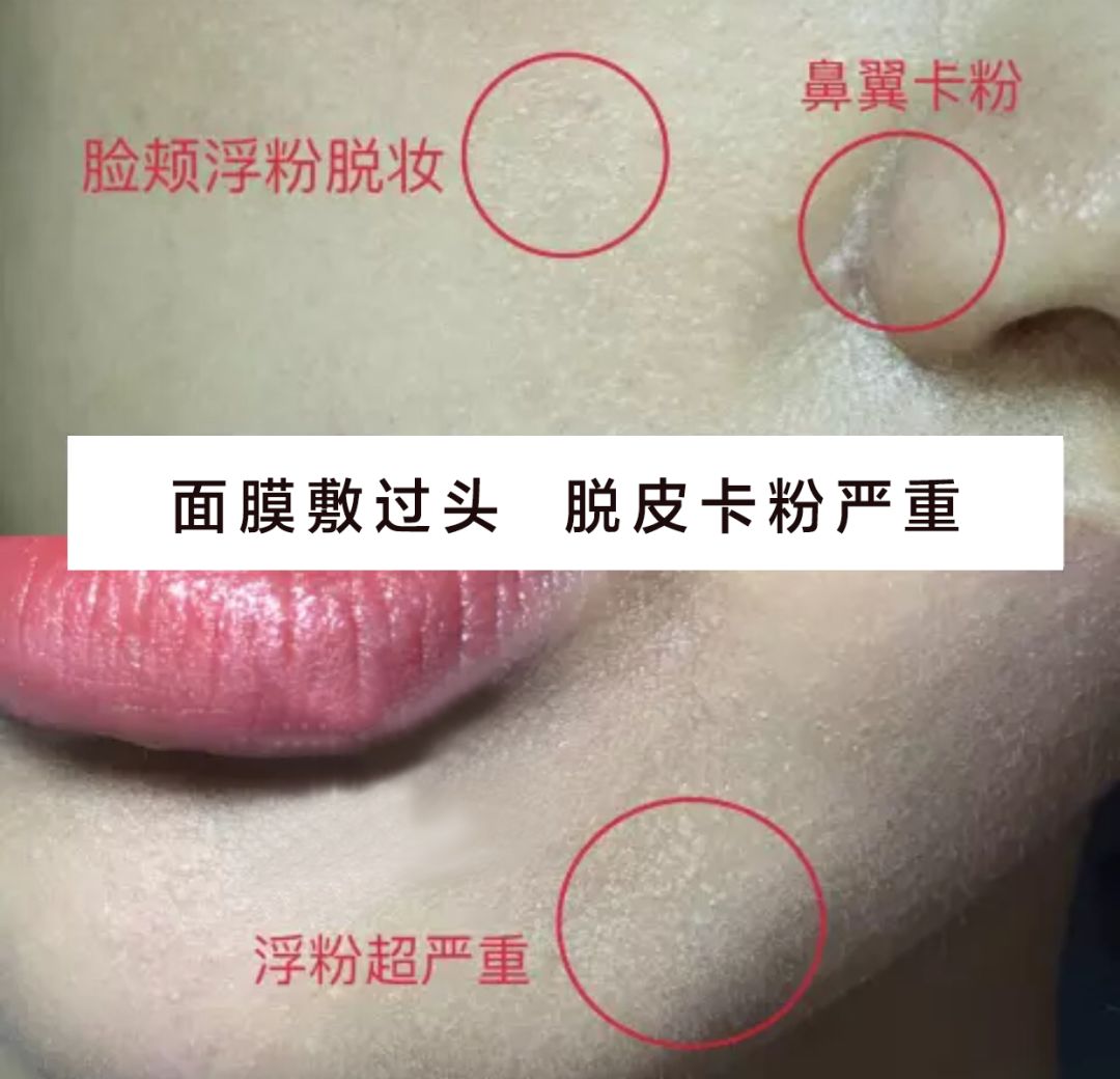 法令纹会让自己显老5到10岁,法令纹显老十岁教你解决