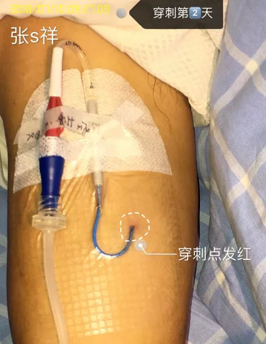 picc穿刺点有脓咋办,picc导管穿刺部位渗血