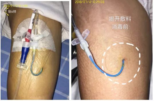 picc穿刺点有脓咋办,picc导管穿刺部位渗血