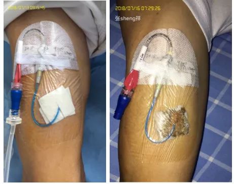 picc穿刺点有脓咋办,picc导管穿刺部位渗血