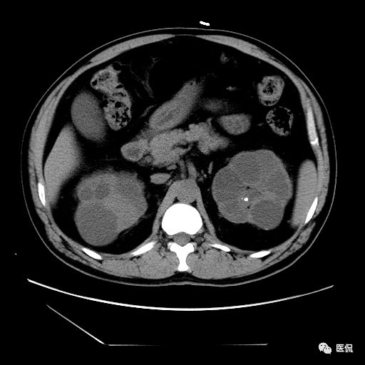 肾功能不全双肾回声稍增强怎么办,肾ct检查双肾萎缩