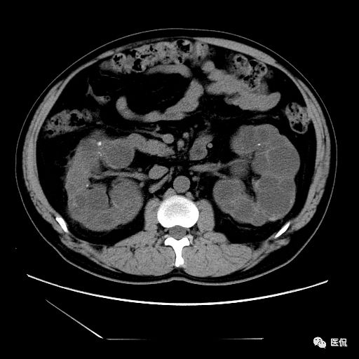 肾功能不全双肾回声稍增强怎么办,肾ct检查双肾萎缩