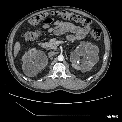 肾功能不全双肾回声稍增强怎么办,肾ct检查双肾萎缩