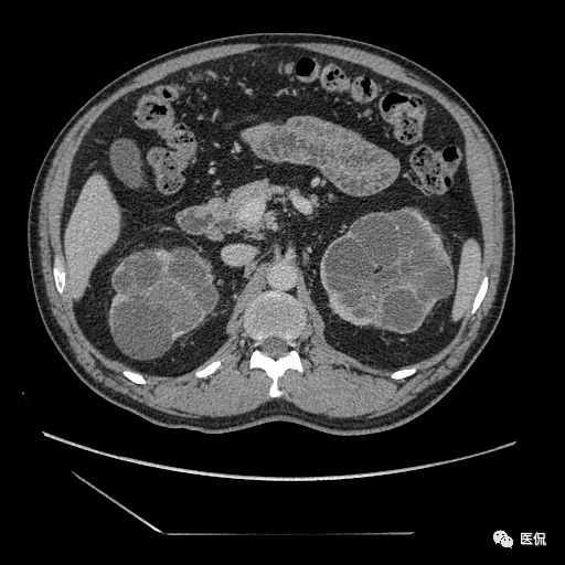 肾功能不全双肾回声稍增强怎么办,肾ct检查双肾萎缩