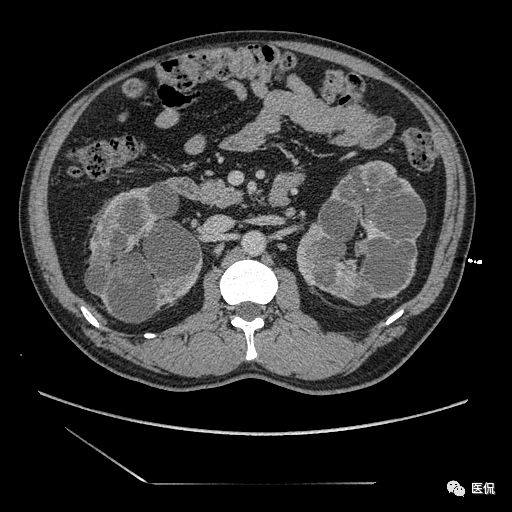 肾功能不全双肾回声稍增强怎么办,肾ct检查双肾萎缩