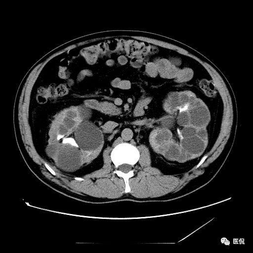 肾功能不全双肾回声稍增强怎么办,肾ct检查双肾萎缩