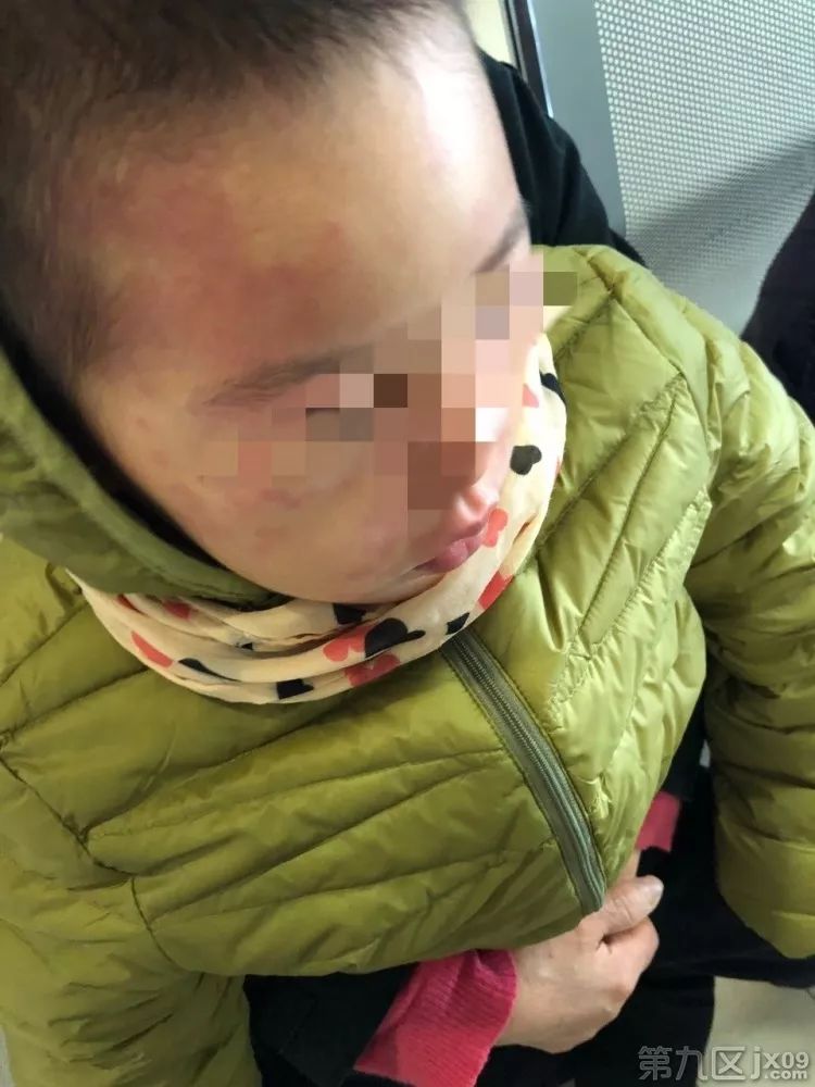孩子吃感冒药过敏起了红疹图片,孩子吃感冒药后脸上有红点点