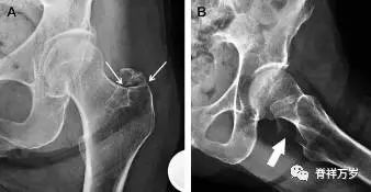 肩关节脱位易漏诊的骨折,放射科容易漏诊的骨折