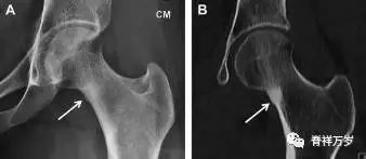 肩关节脱位易漏诊的骨折,放射科容易漏诊的骨折